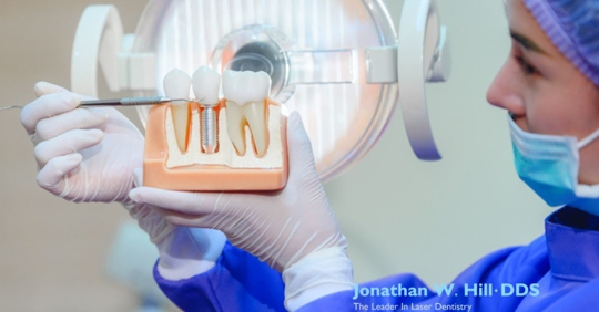 Dentist showing human teeth model and pointing to crown of Dental Implant.