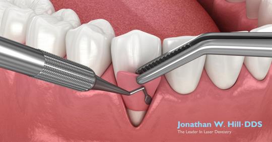 soft tissue grafts gums dental