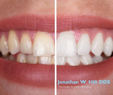 before and after photos of teeth that have been whitened